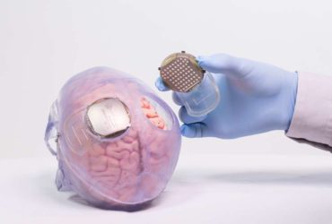Des électrodes placés dans une neuroprothèse