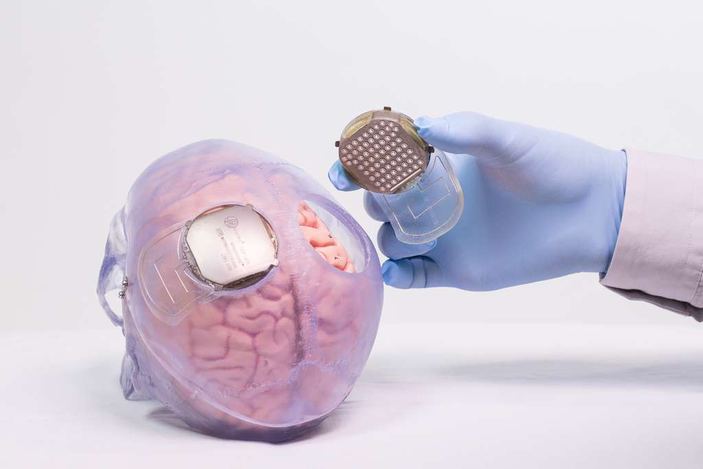 Des électrodes placés dans une neuroprothèse